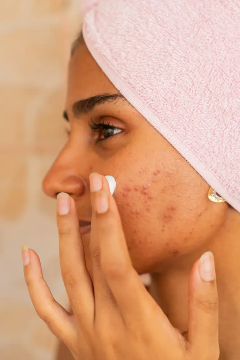 Everyday habits and products that can cause unexpected acne breakouts