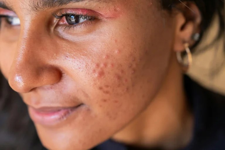 Acne causes and clear skin guide showing common triggers and habits that lead to breakouts